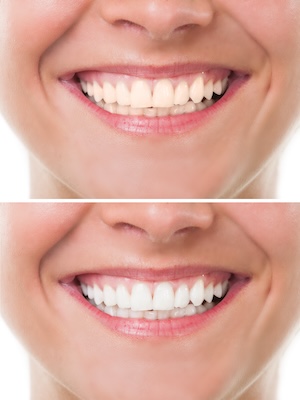 teeth whitening before and after