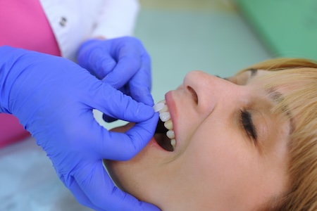 woman getting veneers