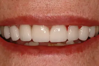 Eight-veneers-after