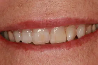 Eight-veneers-before