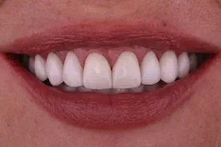 Julie-after-12-veneers