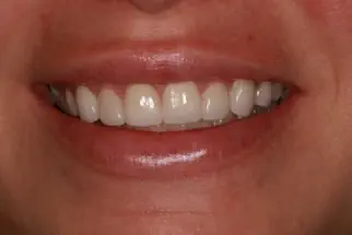 Kaylin-after-8-veneers