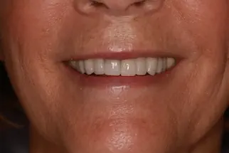 Pat-after-10-veneers