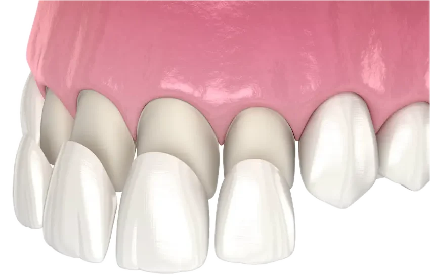 Porcelain Veneers