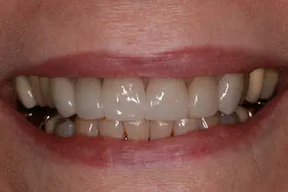 Six-Veneers-after