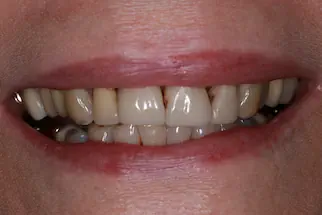 Six-Veneers-before