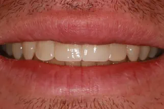 Two-Veneers-after