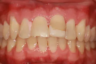 Two-Veneers-before