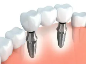 benage-dental-care-dental-implants Cleburne, TX
