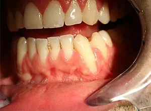 benage-dental-care-gum-grafting