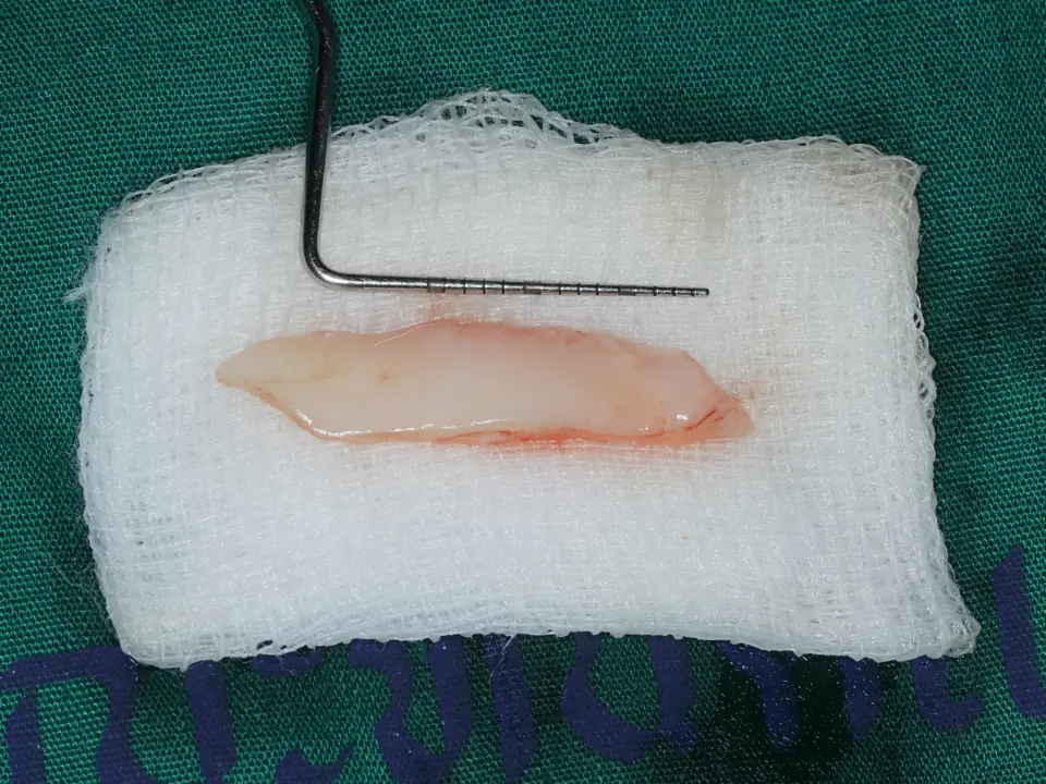 Extracted Retained Teeth