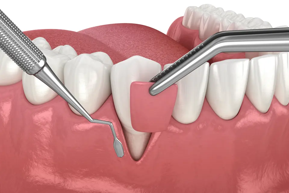 Bone Grafting