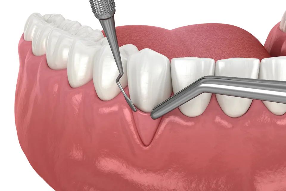 Bone Grafting 2