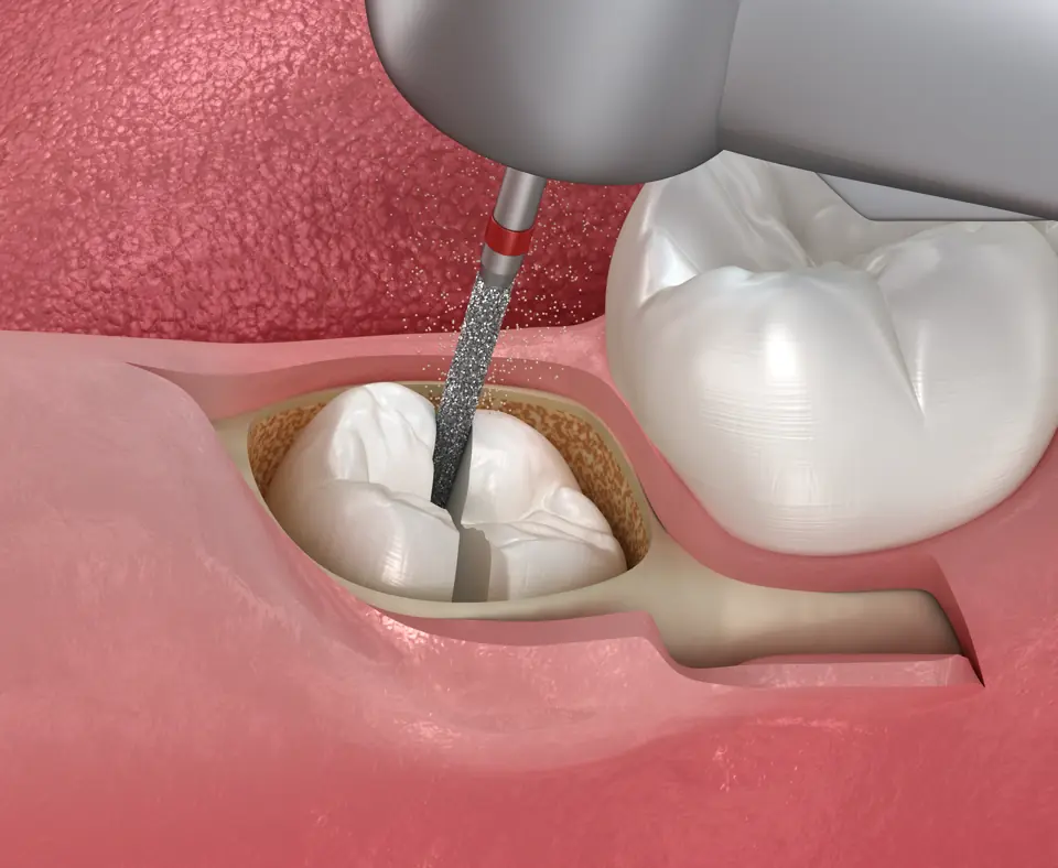 Tooth Extraction 2